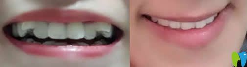 京通口腔隱形牙齒矯正前后對(duì)比圖