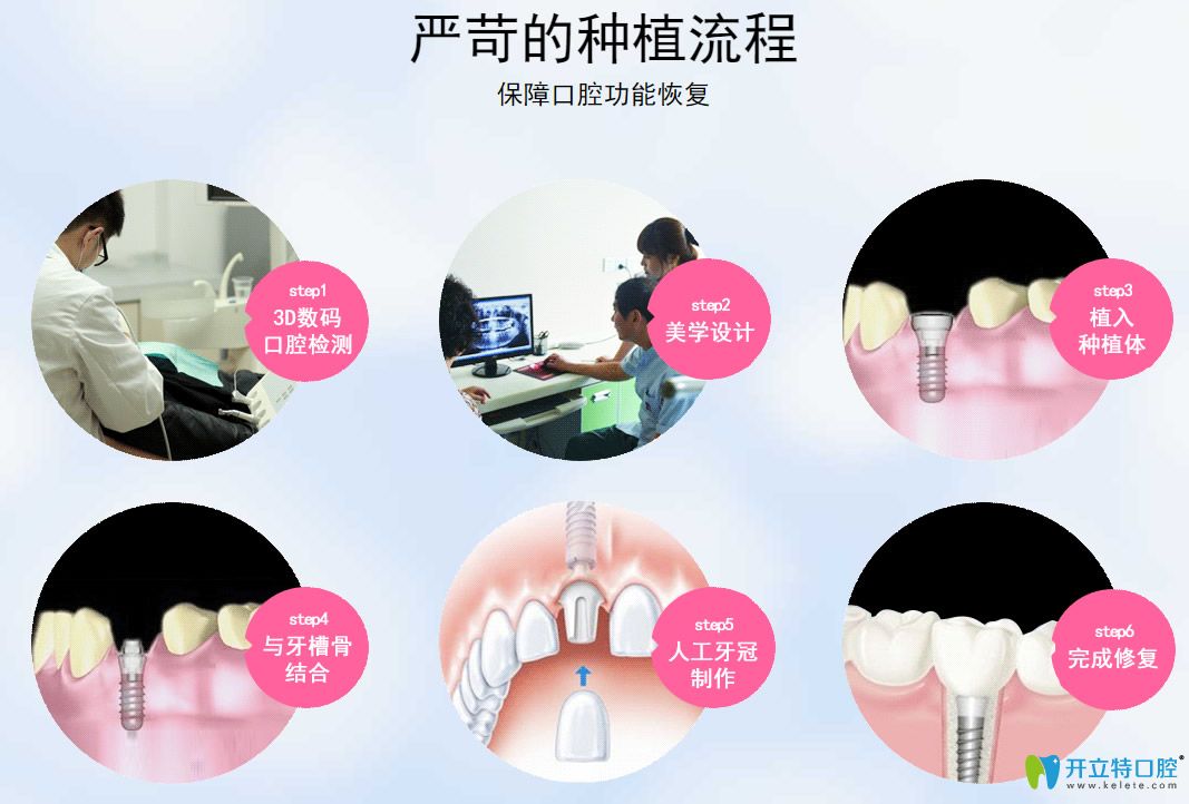 微創(chuàng)種植牙種植流程 微創(chuàng)種植牙種植流程