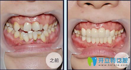 <!--<i data=20240703-sp></i>-->伊萊美牙科李慶云牙齒擁擠矯正前后對(duì)比效果