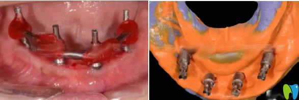 植入種植系統(tǒng)后的照片