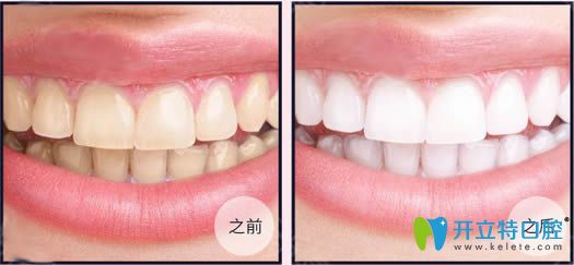 <!--<i data=20240703-sp></i>-->伊萊美王海金超聲波洗牙前后對比圖 <!--<i data=20240703-sp></i>-->伊萊美王海金超聲波洗牙前后對比圖