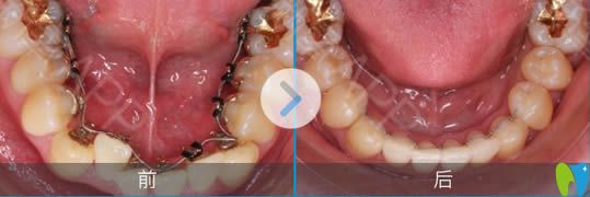 舌側(cè)矯正下頜牙前后對比照 舌側(cè)矯正下頜牙前后對比照