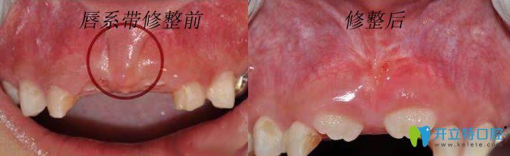 上唇系帶修整術(shù)前后對比圖