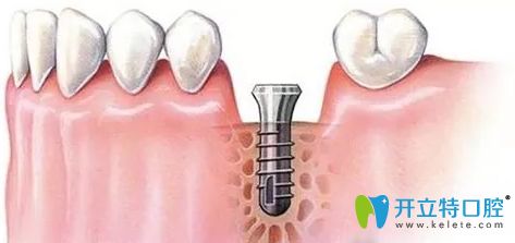 牙周炎對(duì)種植牙有哪些影響