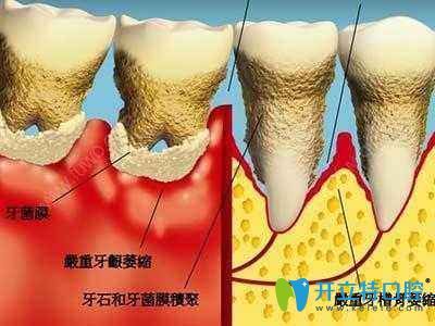 牙齒矯正是否會(huì)導(dǎo)致牙齦萎縮