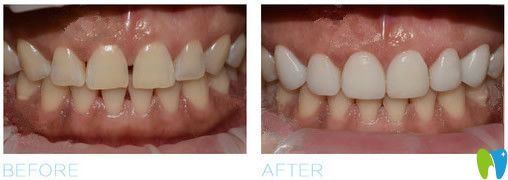 云南華美美萊口腔全瓷牙變化圖