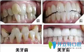鄭杰星醫(yī)生牙齒正畸效果對(duì)比圖 鄭杰星醫(yī)生牙齒正畸效果對(duì)比圖