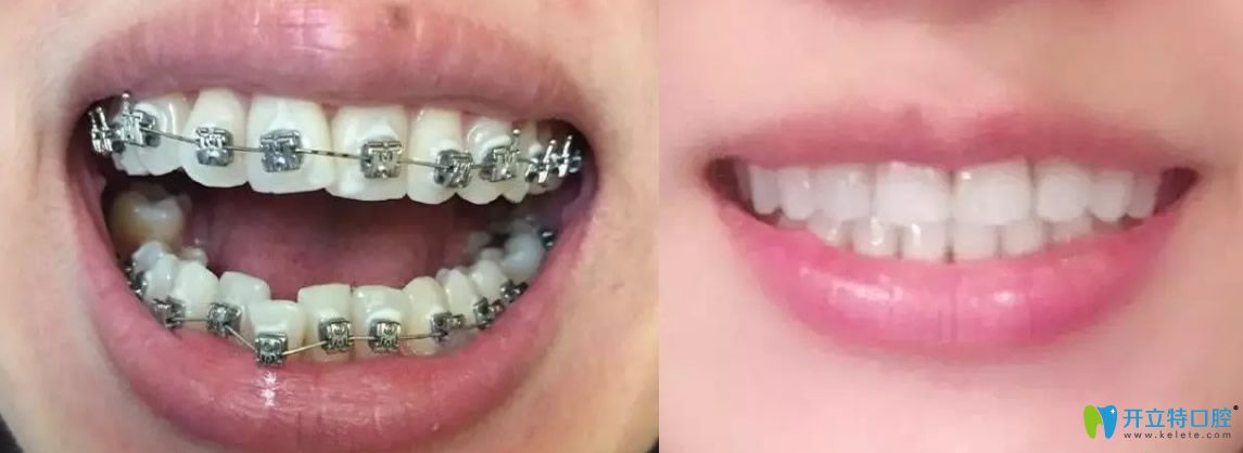 牙齒矯正前后對(duì)比圖