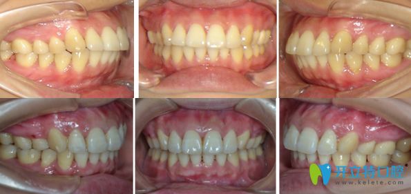 牙齒前突活動翼矯正前后對比圖
