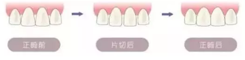 做的片切正畸后悔死了：深究牙齒片切矯正的危害有哪些？