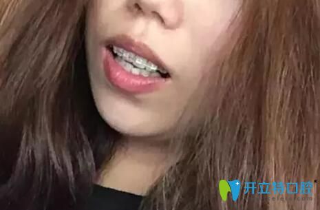 梅州愛麗諾口腔陶瓷半隱形矯正天戴牙套 梅州愛麗諾口腔陶瓷半隱形矯正天戴牙套