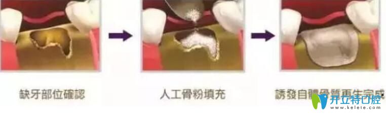 骨粉是個(gè)什么東西？為什么種牙要植骨粉