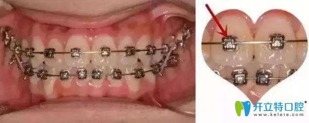 干貨：牙齒矯正托槽掉了怎么辦？托槽掉了必須馬上粘嗎?