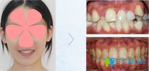 楚丹丹醫(yī)師采用直絲弓矯正技術(shù)的正畸對比效果