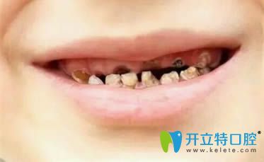 嚴(yán)重的奶瓶齲齒癥狀圖