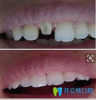 二氧化鋯全瓷牙修復(fù)前后對比效果