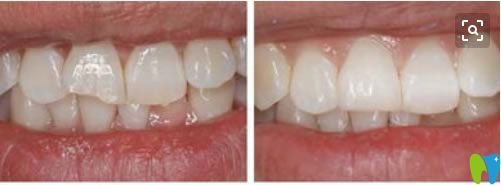 <!--<i data=20240703-sp></i>-->口腔蘭賢發(fā)醫(yī)生前門牙修復(fù)前后對比效果