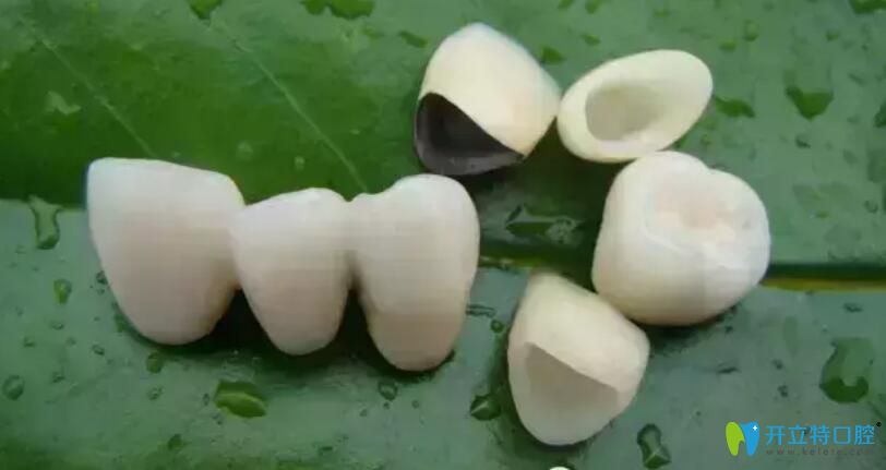 烤瓷牙密合的標(biāo)準(zhǔn)