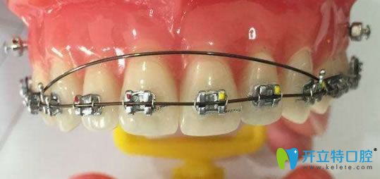 直絲弓和方絲弓的區(qū)別