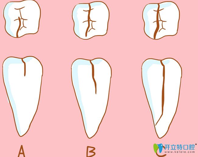 才22歲牙齒就隱裂了，深究牙齒開裂是什么原因造成的？