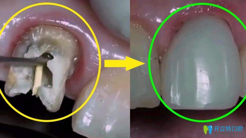 牙齒碎裂后該怎么辦呢？有哪些方法可以補(bǔ)救