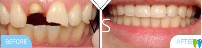 鮑立峰種植牙案例