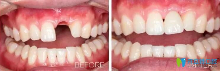 深圳哪家種植牙好？諾德齒科單顆牙種植案例一覽