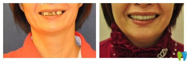 深圳諾德口腔阿諾德·馬丁醫(yī)種植牙案例