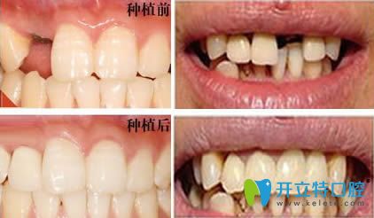 武漢清華陽光口腔王多英單顆牙種植效果圖