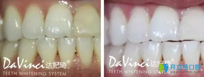 諾得齒科顧客四環(huán)素牙采用達(dá)妃琦植物牙齒美白案例