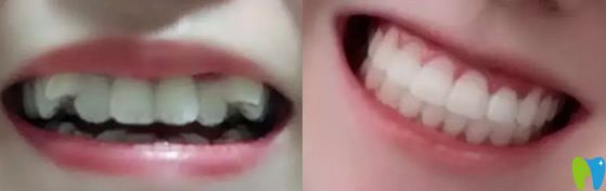 牙齒矯正后反彈做二次矯正效果