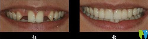 進(jìn)口種植牙前后效果圖