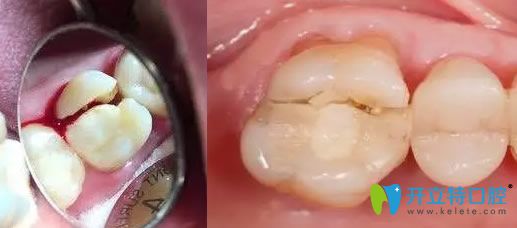 牙齒缺了一塊需要補嗎