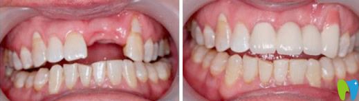即刻種植牙前后對比圖 即刻種植牙前后對比圖