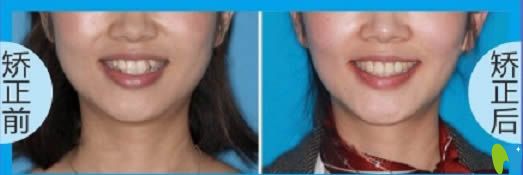 鄭州拜博成人虎牙矯正16個(gè)月對比效果