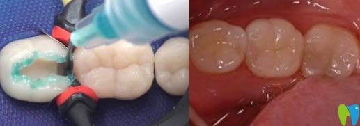 后牙缺失一小塊補牙效果