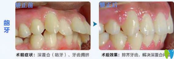 28歲顧客深覆合和齙牙矯正前后對比效果