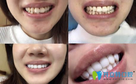 我在沈陽康貝佳口腔做瓷貼面的前后對比照