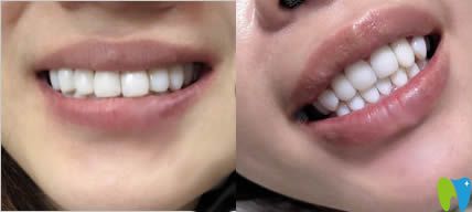 我在沈陽康貝佳口腔做完牙貼面的照片