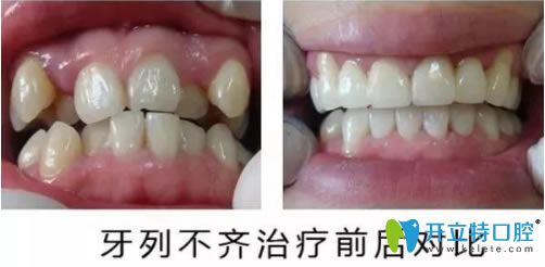 壹加壹戚志鋒主任隱適美牙齒矯正前后對比照