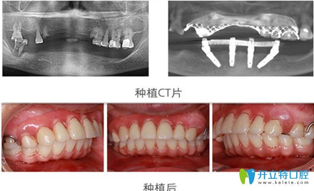 維樂口腔即刻種植前后對比圖