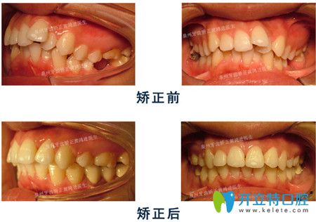 泉州維樂口腔牙齒矯正前后效果圖