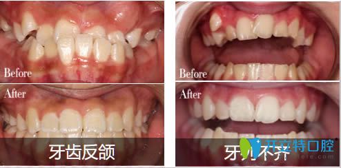 深圳弘和青少年地包天矯正及牙齒擁擠不齊矯正案例圖