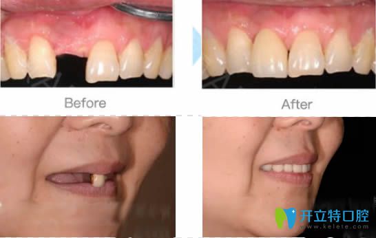 武漢清華陽光陳清華院長單顆及全口種植牙案例