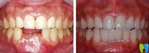 北極星口腔種植牙前后對比圖