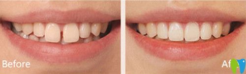 美奧口腔好不好？看杭州美奧瓷貼面變化圖