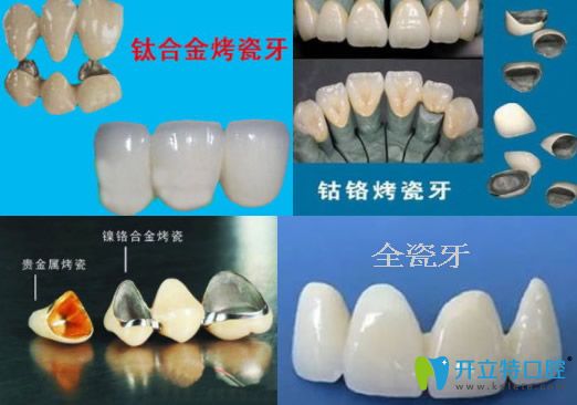 各種常用烤瓷牙圖片大全