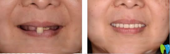 杭州美奧allon4全口種植牙真實案例