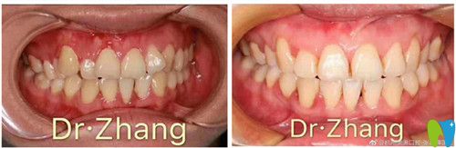 杭州美奧口腔張彼得牙齒矯正效果圖