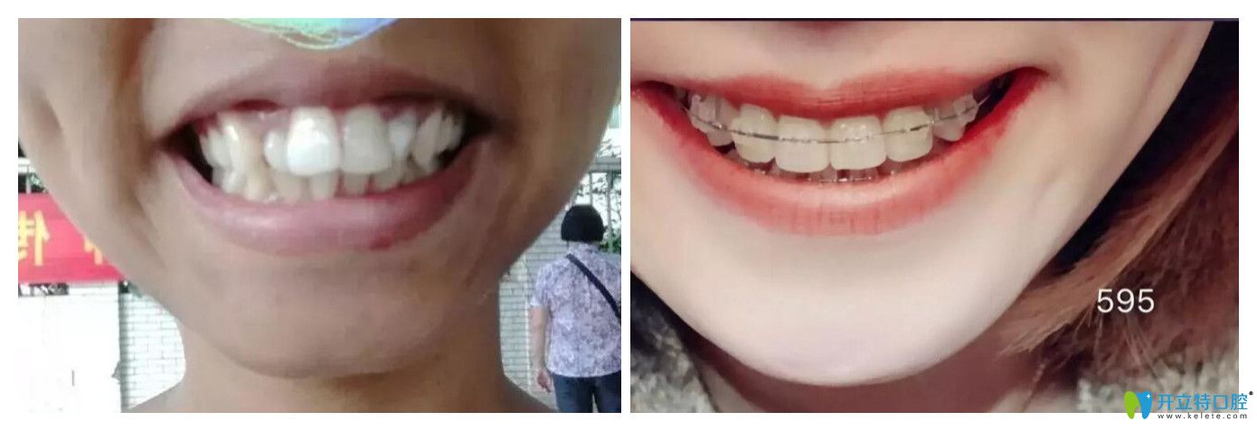 深圳諾德口腔牙齒矯正怎么樣？齙牙矯正案例效果公布